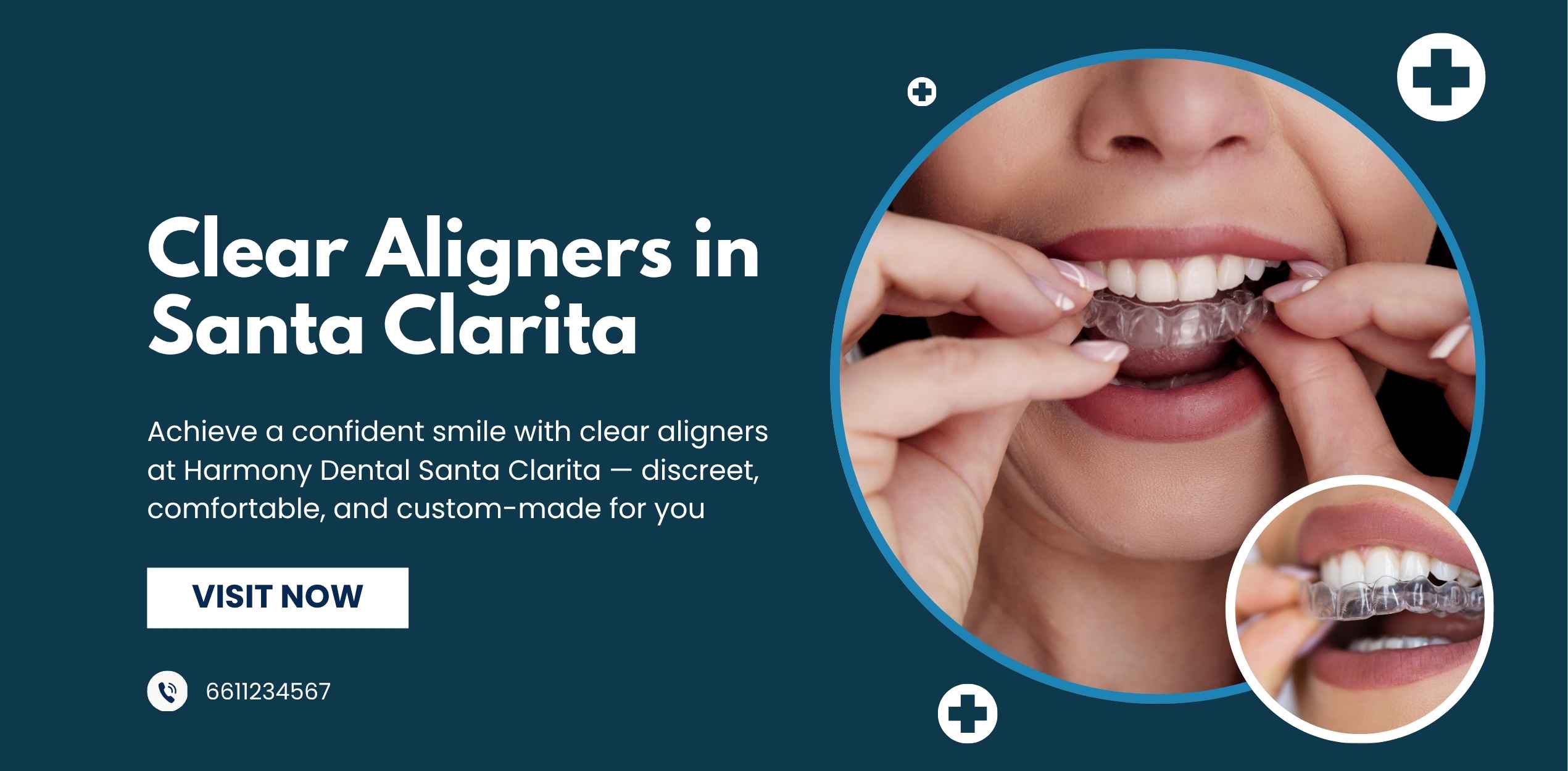 Clear Aligners