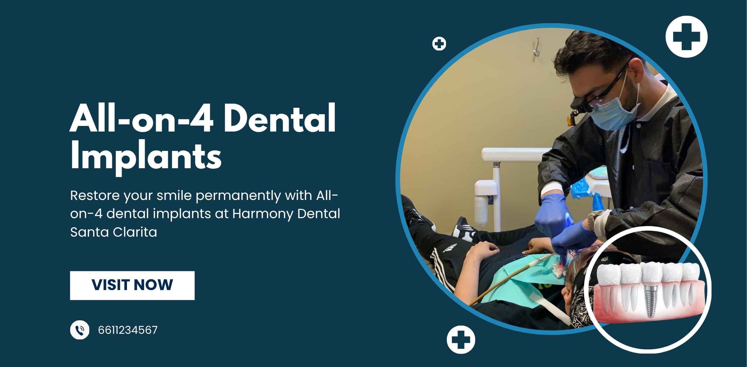 All-on-4 Dental Implants